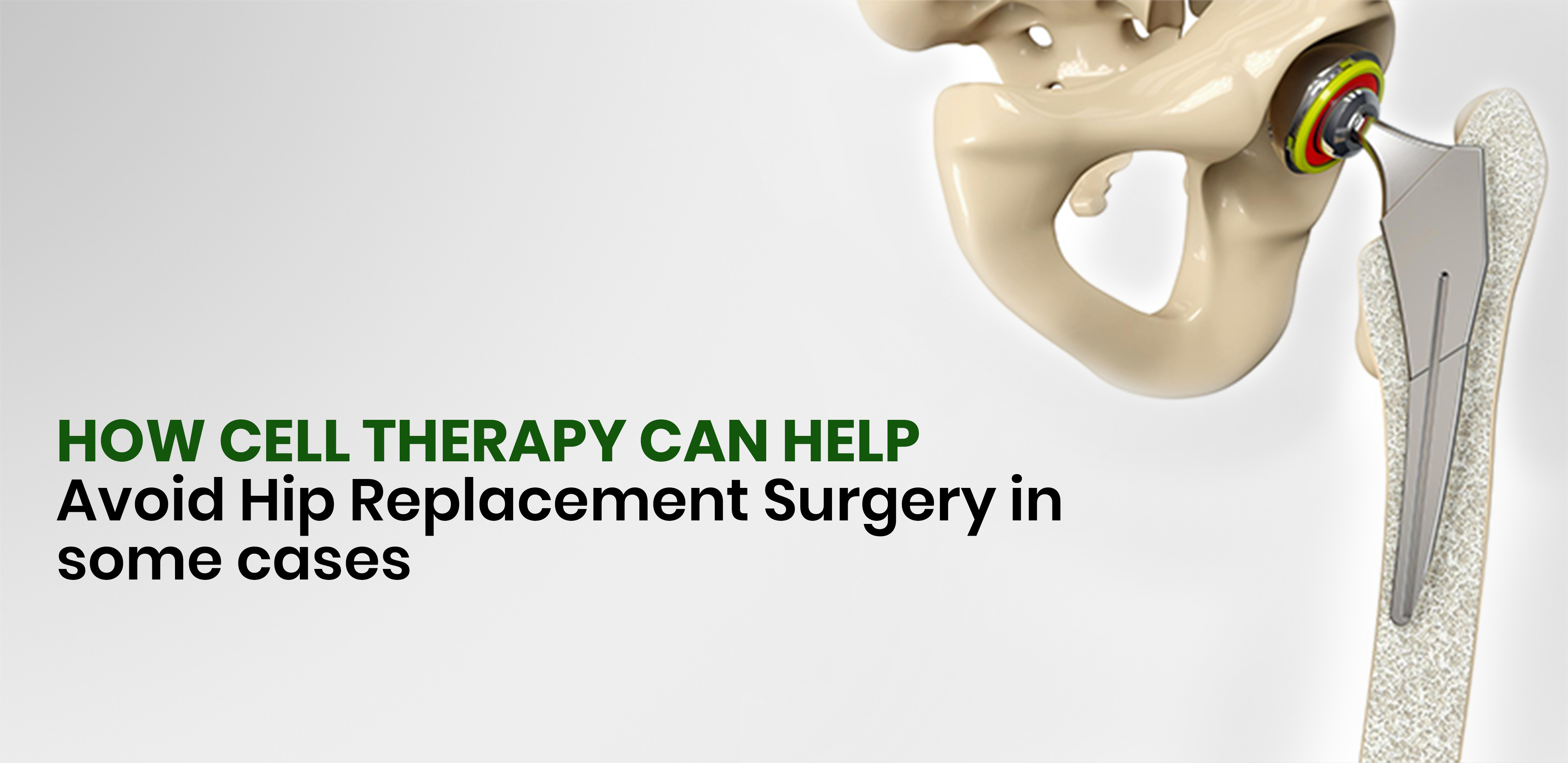 How Cell Therapy Can Help Avoid Hip Replacement Surgery in some cases